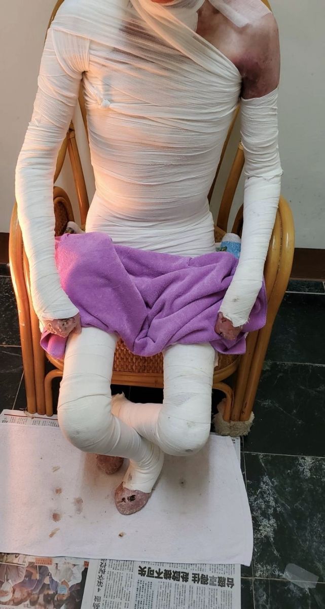 泡泡龍病患全身表皮(皮膚、口腔、眼睛、消化道等等)異常脆弱,每天都需要大量的滅菌不織布紗布來包覆傷口。 泡泡龍協會/提供